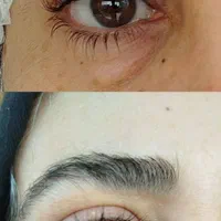 حذف پف پلک و افتادگی بوتاکس،ژل،بوکال،سانترال،هایفو|خدمات آرایشگری و زیبایی|تبریز, |دیوار