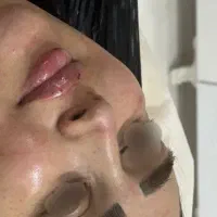 تخفیفات تزریق ژل لب گونه چانه فک بابهترین مواد