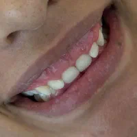 جشنواره کامپوزیت زیبایی دندان با قیمت استثنایی|خدمات آرایشگری و زیبایی|تهران, سلسبیل شمالی|دیوار