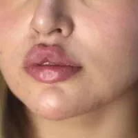 تزریق ژل و بوتاکس و کاشت نخ و مزوژل های جوان ساز|خدمات آرایشگری و زیبایی|شیراز, ابیوردی|دیوار