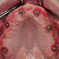 دندانپزشکی ایمپلنت دیجیتال و فوری با اقساط بلندمدت|خدمات آرایشگری و زیبایی|تبریز, |دیوار