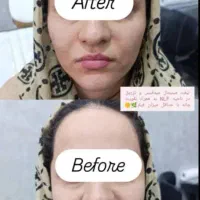 تزریق تمام اقساط بدون پیش پرداخت ژل،بوتاکس،مزو|خدمات آرایشگری و زیبایی|قم, بکایی|دیوار