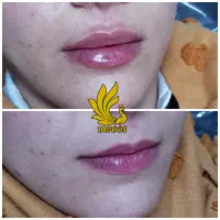 فیشیال مردانه تخصصی + بوتاکس و مزوتراپی|خدمات آرایشگری و زیبایی|رفسنجان, |دیوار