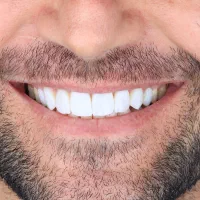 کامپوزیت دندان، ایمپلنت و لمینیت با پرداخت یکساله