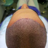 کاشت مو و ابرو|آرایشی، بهداشتی، درمانی|کرج, دانشگاه هنر تهران (پردیس کرج)|دیوار