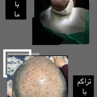 کاشت مووابرو مادام العمر درشیراز برای اصفهانی‌ها|خدمات آرایشگری و زیبایی|اصفهان, مرداویج|دیوار