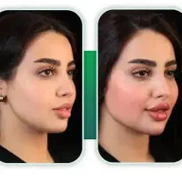 تزریق ژل و بوتاکس از ۷۹۹|خدمات زیبایی و سلامت|تهران, شهرک ولیعصر جنوبی|دیوار