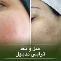درمان پوست جوش لک منافذ فیشیال پاکسازی پوست|خدمات آرایشگری و زیبایی|کرمانشاه, |دیوار