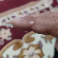 درمان بیماری های مقاربتی