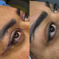پیکرتراشی لیفت رینو بلفارو غبغب