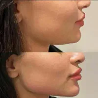 of تا فرداژل و بوتاکس مزو ژل مزو تراپی  prp|خدمات آرایشگری و زیبایی|مشهد, امام رضا (ع)|دیوار