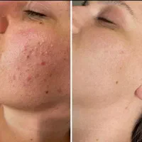 ژل بوتاکس فیلر چشم زاویه فک گونه چانه فشیال بیکینی|خدمات آرایشگری و زیبایی|قم, زنبیل آباد|دیوار