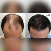 استخدام دستیار کاشت ابرو و مو مبتدی|استخدام درمانی، زیبایی، بهداشتی|تهران, حکمت|دیوار