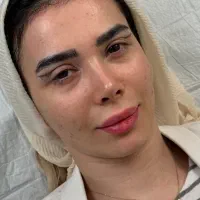 بلفارو زیبایی پلک لیفت چشم