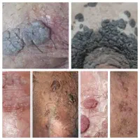 حذف طبیعی زگیل.تبخال نواحی خصوصی
