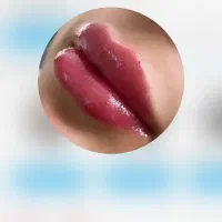 ژل و بوتاکس