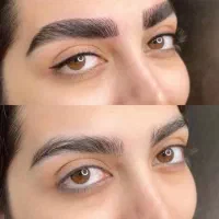 فیبروز ابرو هزینه مواد