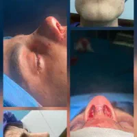 عمل زیبایی بینی در مازندران|خدمات آرایشگری و زیبایی|قائمشهر, |دیوار