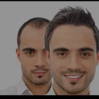 کاشت مو در شهرستان چابهار