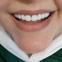 دندان مصنوعی.کامپوزیت.روکش