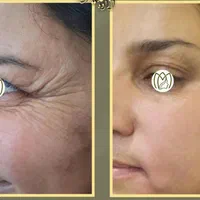 ژل بوتاکس،لابیاپلاستی،حذف لک،ریموو تتو،لاغری|خدمات آرایشگری و زیبایی|ارومیه, |دیوار