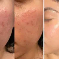 فیشیال و پاکسازی صورت جشنواره یلدایی|خدمات آرایشگری و زیبایی|شیراز, شهرک مهدیه|دیوار