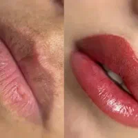 شیدینگ لب بدون درد تضمینی