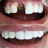ایمپلنت کره ای درجه یک 8500 و 11400 ضمانت و اقساط|خدمات زیبایی و سلامت|تهران, شهرآرا|دیوار