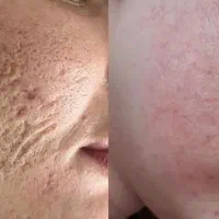 جشنواره پاکسازی تخصصی صورت وبدن