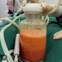 ساکشن شکم پهلو ۱۰ ،بلفارو ۶،دایرکت ابرو۱۰
