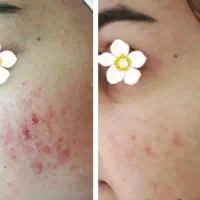 آموزش فیشیال تخصصی. مزو جوانساز صورت