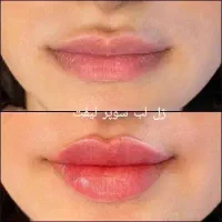 تخفیف ۵۰درصدی تزریق ژل چربی بوتاکس و جراحی زنان|خدمات آرایشگری و زیبایی|رشت, گلسار|دیوار