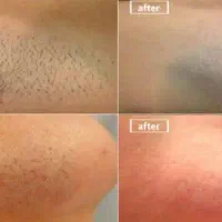 لیزر موژان|خدمات آرایشگری و زیبایی|تهران, اتابک|دیوار