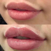 تزریق ژل لب با تکنیک Mمزوژل جوانساز فیلر بادی