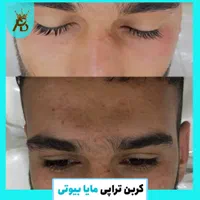 روشن کننده صورت بیکینی ،کربن تراپی تخصصی مابیوتی|خدمات آرایشگری و زیبایی|یاسوج, |دیوار