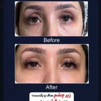 تخفیف ویژه ژل و بوتاکس ونخ های لیفت