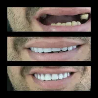 دندانسازی ( پروتز متحرک) لمینتی و کامپوزیتی|خدمات آرایشگری و زیبایی|مشهد, احمدآباد|دیوار