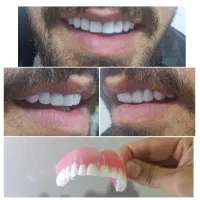 قبولی مقداری دست کامل