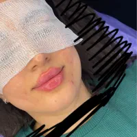 تخفیفات جمعه سیاه با بوتاکس رایگان توسط پزشک|خدمات آرایشگری و زیبایی|قم, هفت تیر|دیوار