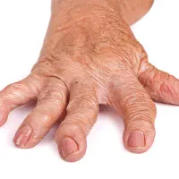 خداحافظی با درد مفاصل ودرد روماتیسم با قدرت طبیعت|خدمات آرایشگری و زیبایی|اردبیل, |دیوار