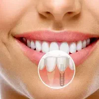 لبخندی زیبا با ایمپلنت وتضمینی