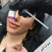 تزریق بوتاکس و فیلر|خدمات آرایشگری و زیبایی|رشت, خواهر امام|دیوار