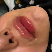 تزریق ژل لب روسی /فول فیس/شقیقه/بوتاکس، آنزیم|خدمات آرایشگری و زیبایی|تهران, فلاح|دیوار