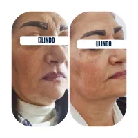 تخفیفات یلدایی کلینیک زیبایی لیندو