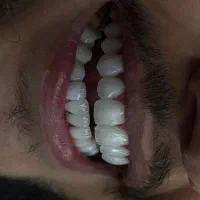 دندانپزشکی،لمینت،کامپوزیت،عصب کشی|خدمات آرایشگری و زیبایی|تهران, مشیریه|دیوار