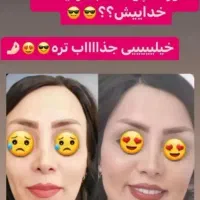 پک چاقی صورت * تضمینی*|آرایشی، بهداشتی، درمانی|قم, شهید رجایی|دیوار