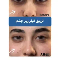 لیزر و بوتاکس ژل ،پی ارپی،هایفو، بلفارو،بوکال فت