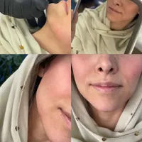 جشنواره ژل و فیلر بوتاکس پی آر پی مزو جوانساز لیزر|خدمات آرایشگری و زیبایی|رشت, گلسار|دیوار