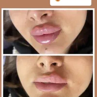 زیبایی چهره هارا ماندگار کن با بوتاکس و فیلر|خدمات آرایشگری و زیبایی|سبزوار, فرهنگیان|دیوار