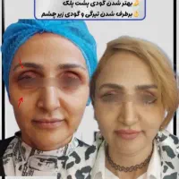 طرح اقساطی ویژه تزریق فول فیس فیلر/بایوفت و نانوفت|خدمات آرایشگری و زیبایی|مشهد, هنرستان|دیوار